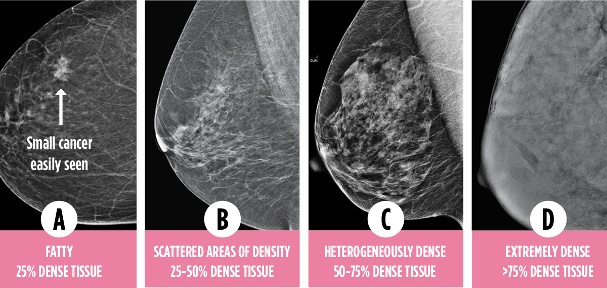 4 breasts Mammogram showing breats density