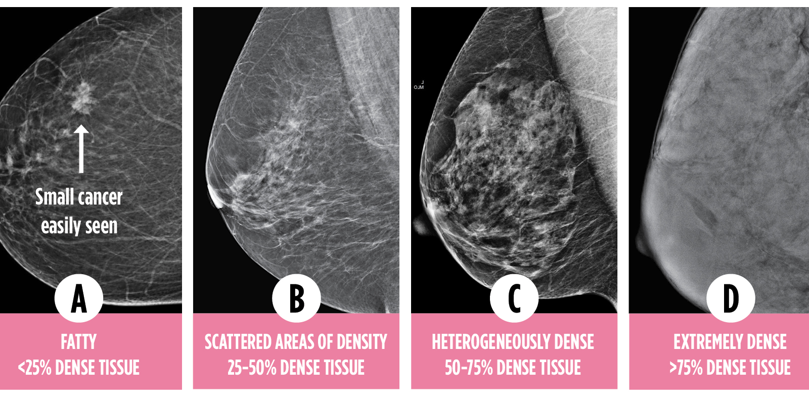 Breast (Chest) Density Information for Ontario Breast Screening Program  Participants