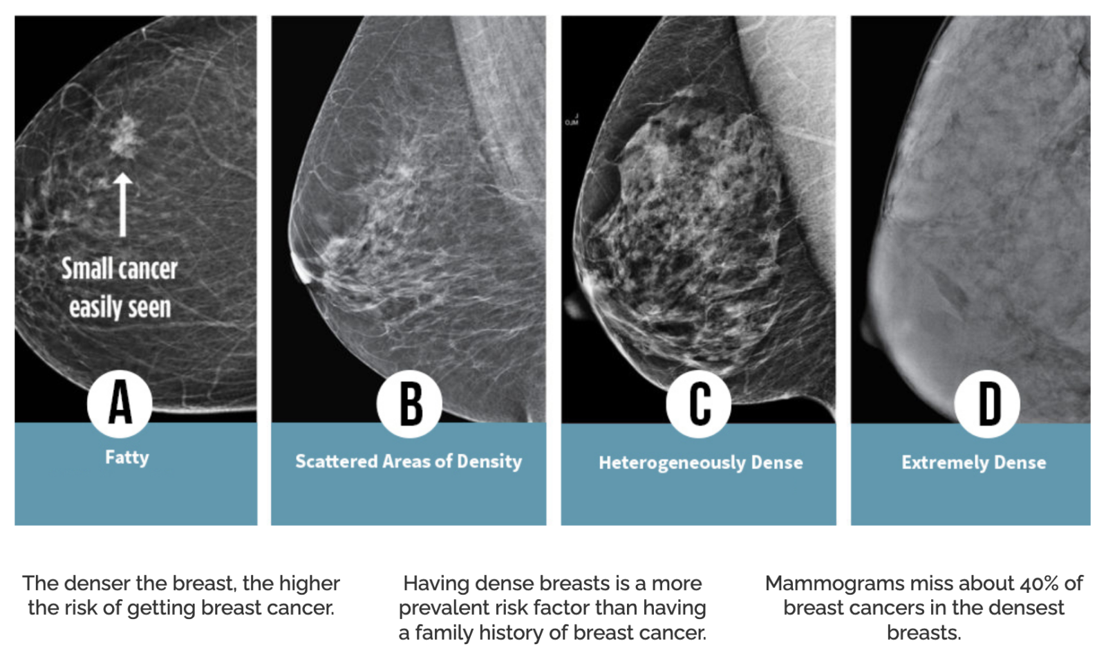About Dense Breasts